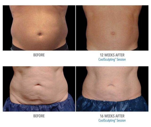 Dr. Melinda Silva MD coolsculpting before and after Dr. Melinda Silva MD coolsculpting before and after