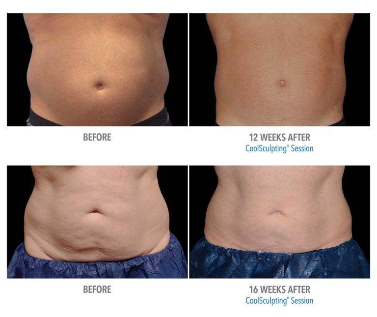 Dr. Melinda Silva MD coolsculpting before and after Dr. Melinda Silva MD coolsculpting before and after