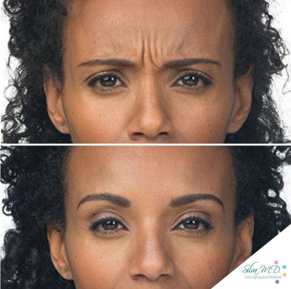 Dr. Melinda Silva MD botox filler before and after Dr. Melinda Silva MD botox filler before and after