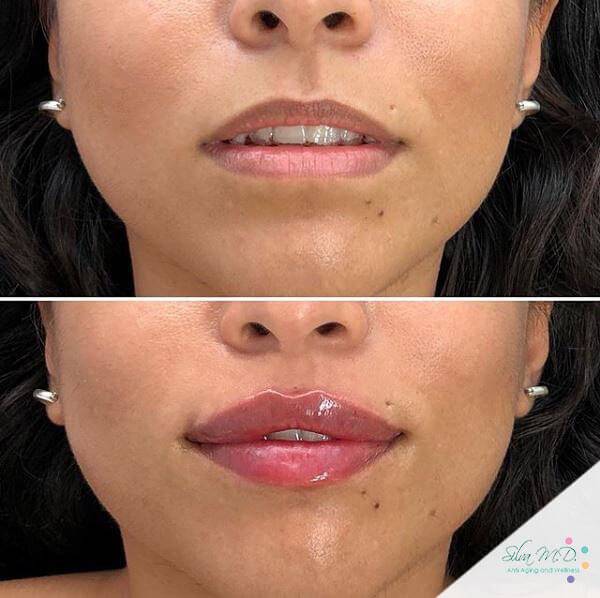Dr. Melinda Silva MD juvederm botox lip filler before and after Dr. Melinda Silva MD juvederm botox lip filler before and after