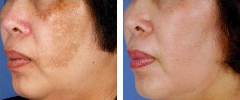 Dr. Melinda Silva MD - ZO Peel Dr. Melinda Silva MD - ZO Peel