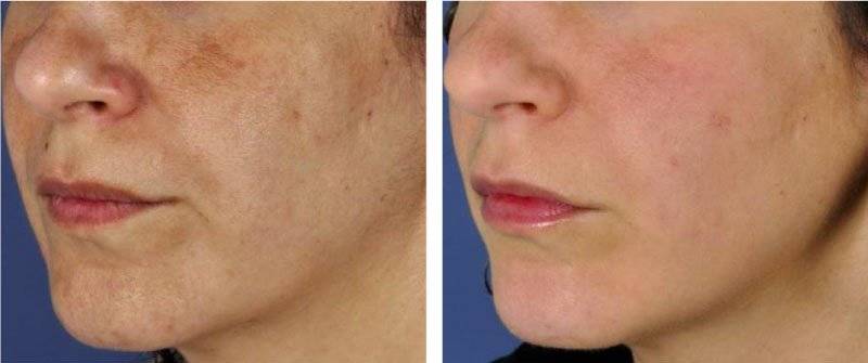 Dr. Melinda Silva MD ZO Peel 2 Dr. Melinda Silva MD ZO Peel 2