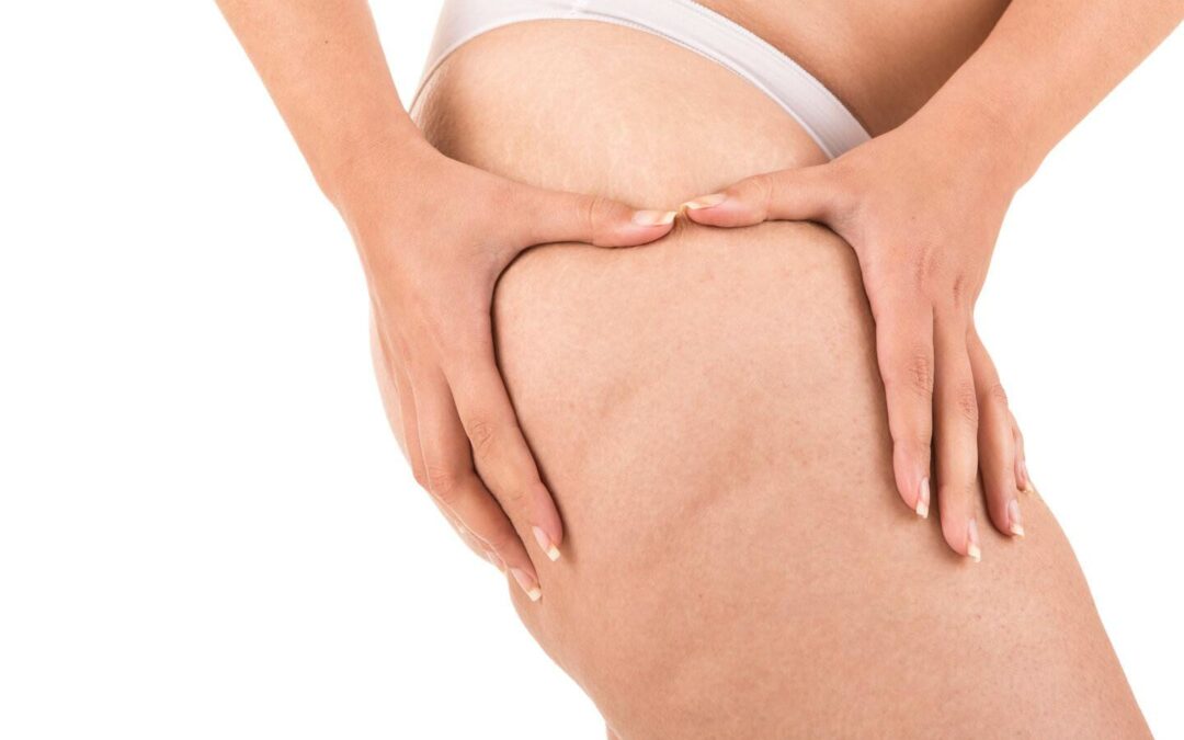 Top 7 Advantages of Using Coolsculpting® to Reduce Cellulite